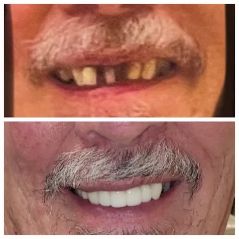 Before and After Images of a patient missing front teeth