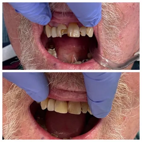 Before and After Images of a patient missing front teeth