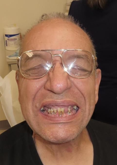 A patient with broken teeth before dental treatment